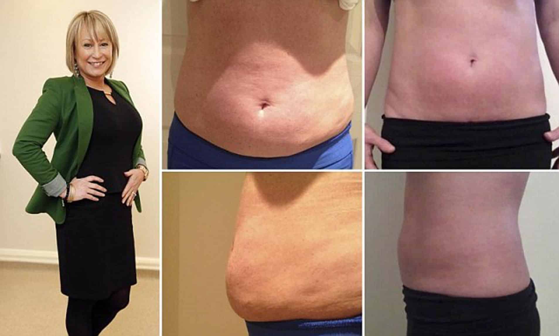 Abdominal Fat Loss Injection