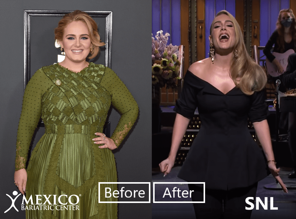 Adele Gastric Sleeve