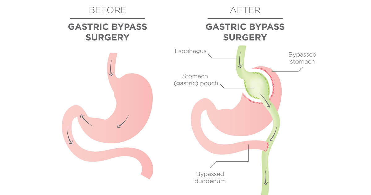 After Gastric Bypass