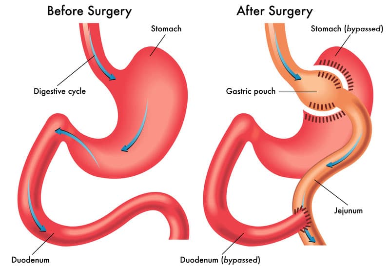 After Gastric Bypass