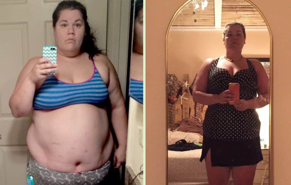 After Gastric Bypass