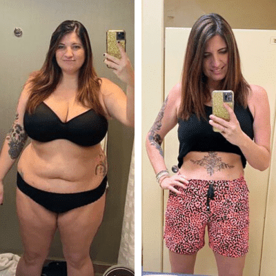 After Gastric Bypass