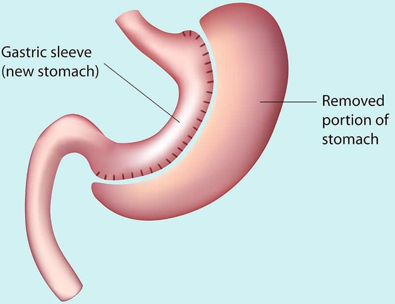 After Sleeve Surgery After Sleeve Surgery