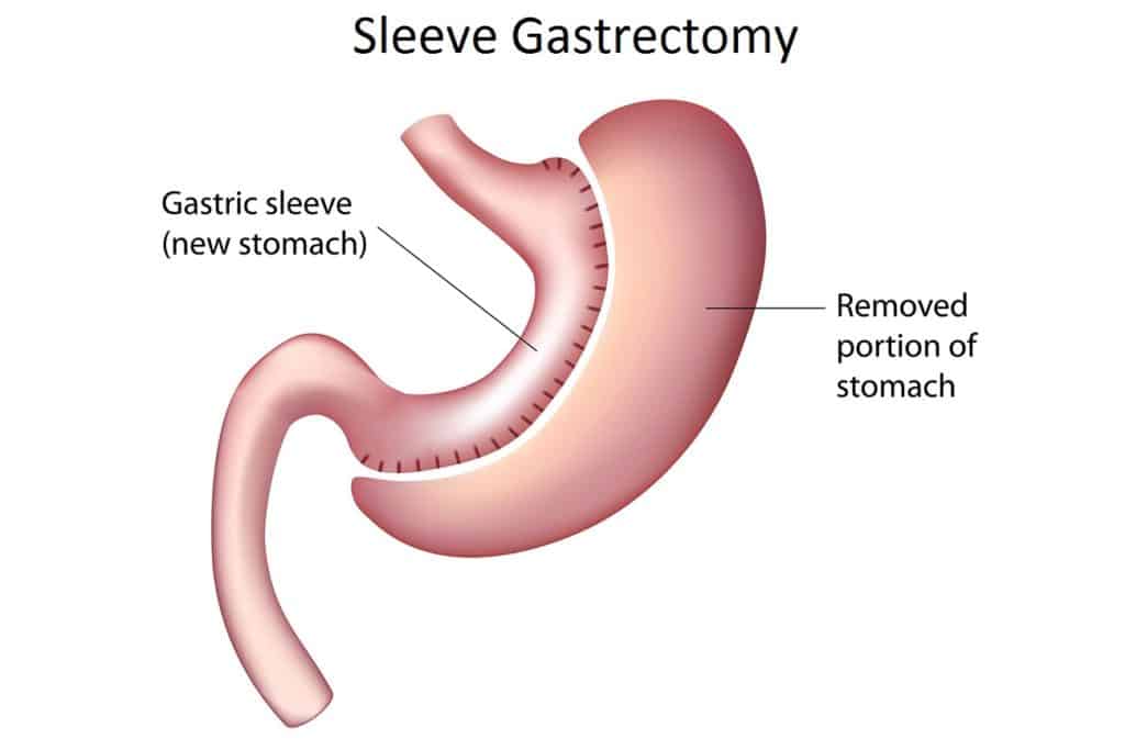 After Sleeve Surgery After Sleeve Surgery