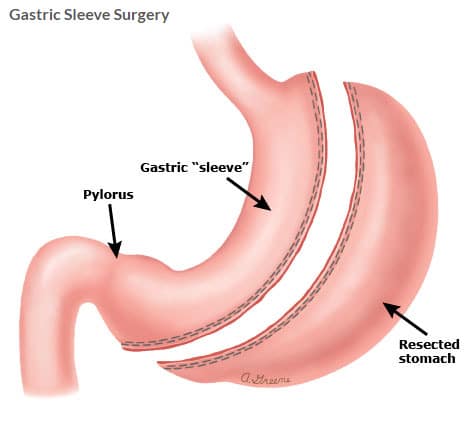 After Sleeve Surgery After Sleeve Surgery